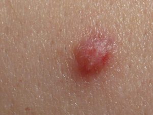 HPV