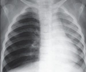 tuberculose-infantil